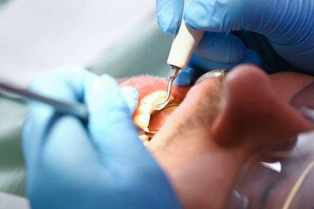 Best Emergency Wisdom Tooth Extraction in Chuluota, FL